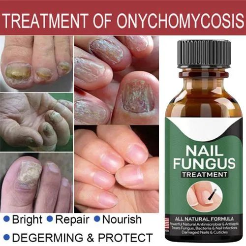 Fast Nail Fungal Treatments Nail Repair (H)