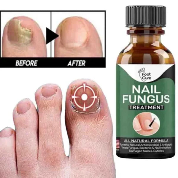 Fast Nail Fungal Treatments Nail Repair (H)